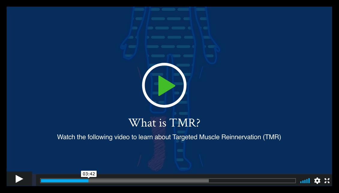 What Is Targeted Muscle Reinnervation (TMR) Surgery?